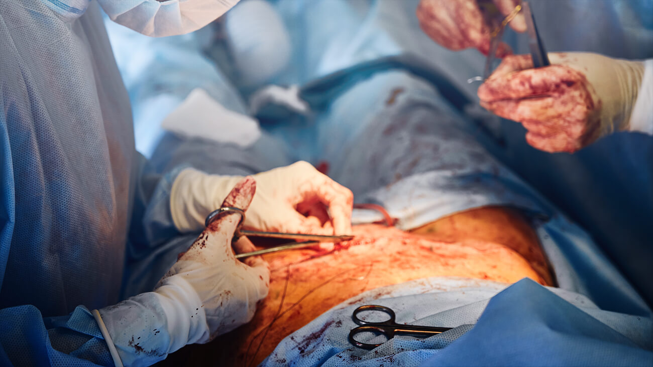 How Much Will A Tummy Tuck Cost You In 2022